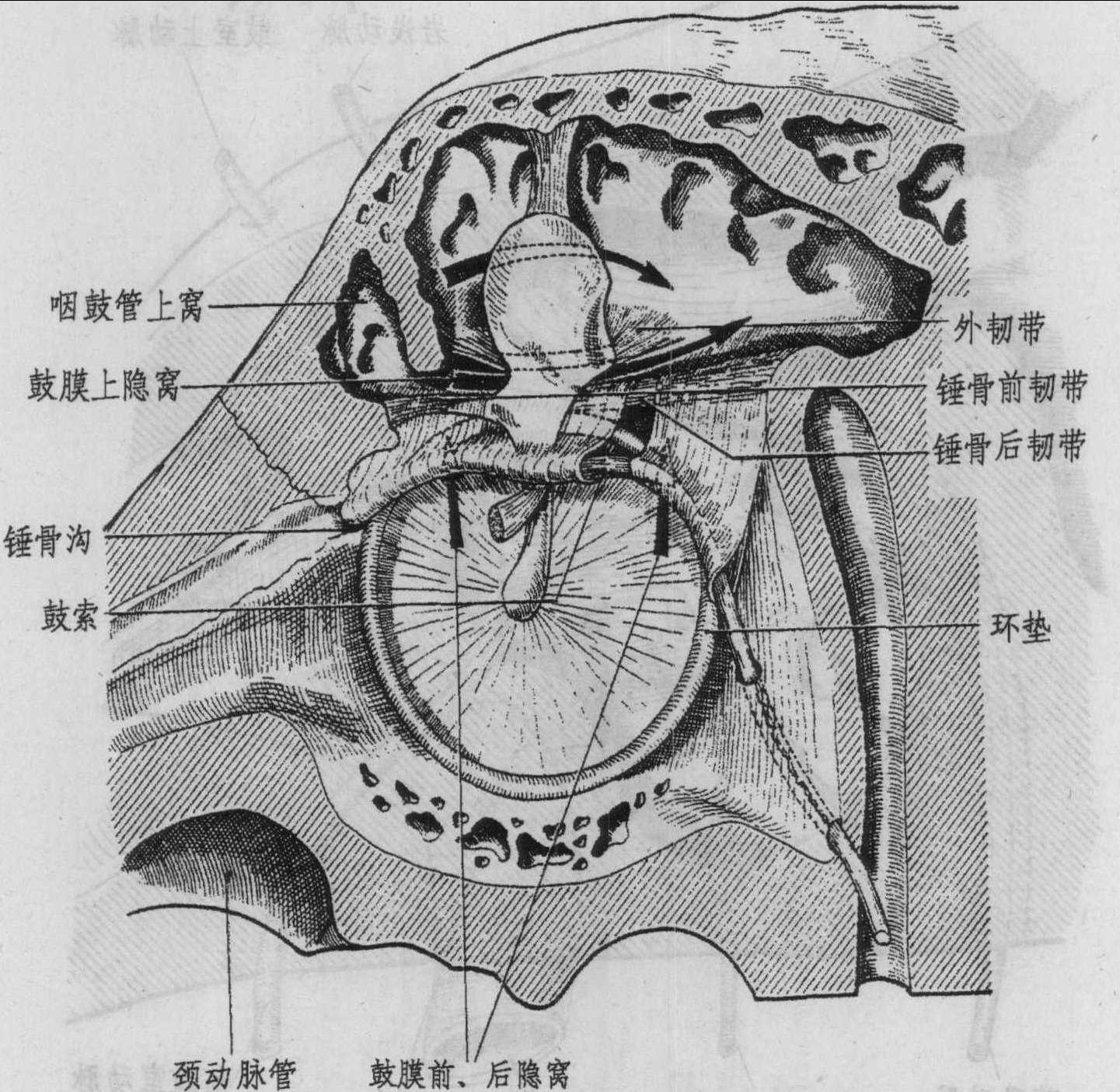 二、上層或鼓室上隱窩或上鼓室